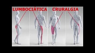 CRURALGIA NERVIO CRURAL O FEMORAL SE SUELE CONFUNDIR CON LA CIATICA CAUSAS BIODESCODIFICACION