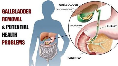 Don't let the Medical Mafia take out your gallbladder. It has a function