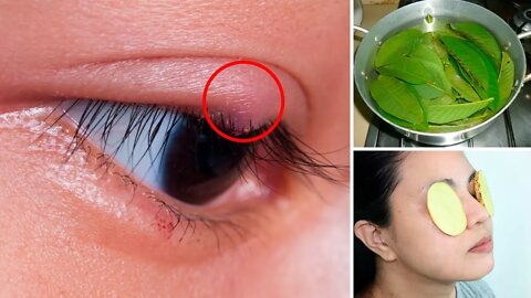 How to Get Rid of a Sty (Stye) - 4 Effective Home Remedies