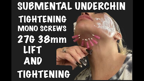 Submental Tightening Using PDO Screws