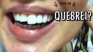 FACETAS DE RESINA: precisou DESGASTAR meus dentes? meu DENTE QUEBROU?