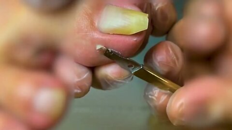 Manicure Unclogging the toenail Solve your problem #12 | 2022 Video
