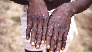 California governor declares monkeypox state of emergency