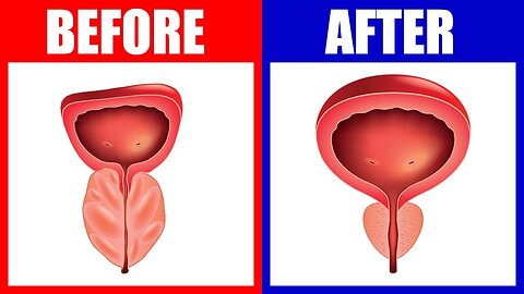 How to Shrink Your Prostate Naturally: The #1 Nutrient You Need