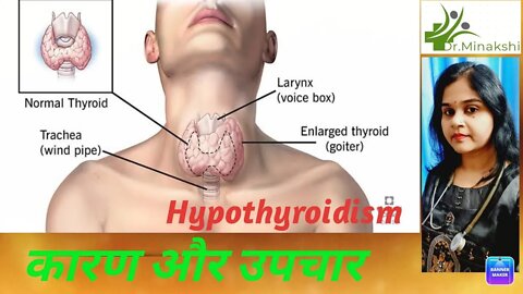 Hypothyroidism ki best homeopathic medicine #drminakshihomeopathicconsultant