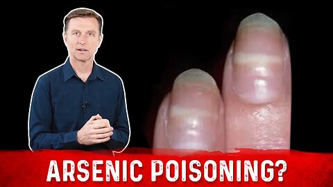 Identify Arsenic Poisoning Through Your Nails