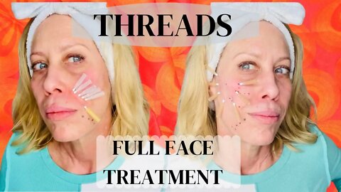 Full Face of Threads -Collagen and Volume