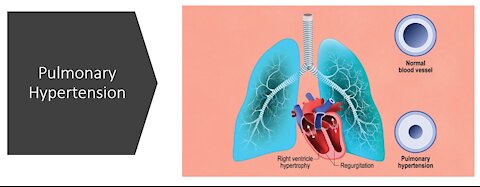 Pulmonary Hypertension - Natural Treatment