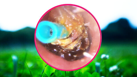 Ear Wax Removal With Clam Relaxing Music #32