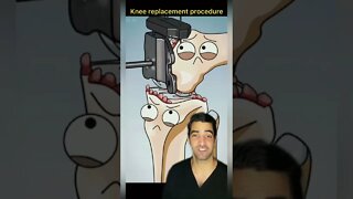 Knee Surgery