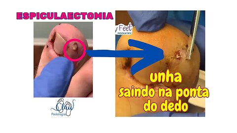 Cirurgia de UNHA ENCRAVADA satisfatório #unhas #pes #dor #podologia #procedimento #profissional