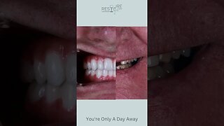Thomas M. Restore in 24 Dental Implant Smile Transformation