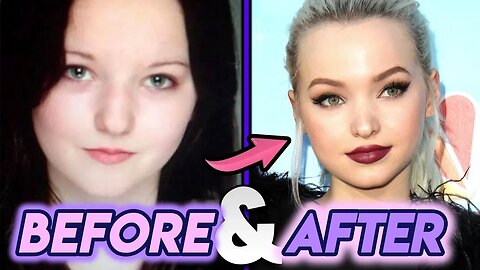 Dove Cameron | Before and After Transformations | Complete Plastic Surgery Procedures!