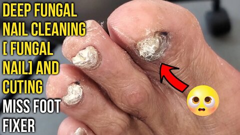 Deep Fungal Nail Cleaning [ FUNGAL NAIL] and cutting By Miss Foot Fixer Marion Yau