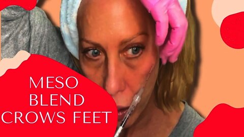 Meso Blend with Tox & Filler Treat Crowsfeet and Smile Lines