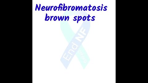 Neurofibromatosis Brown Spot #shorts #ytshorts #nf1 #neurofibromatosis #neurofibroma