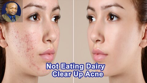 Does Taking Dairy Out Of The Diet Clear Up My Acne?