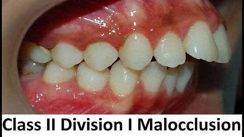 Can Class II Division I of Malocclusion Be Treated With Orthotropics by Prof John Mew