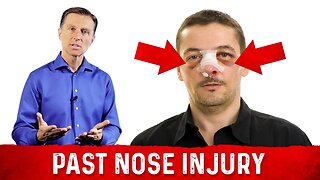 Post Nose Injury – Headache Pain Relief – Acupressure Techniques by Dr. Berg