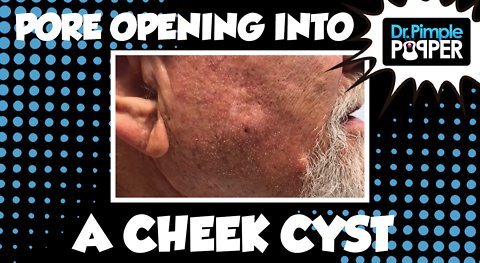 Pore Opening into a Cheek Cyst