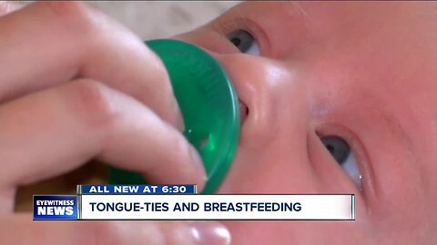 Could the procedure to fix a tongue-tie help your baby breastfeed?