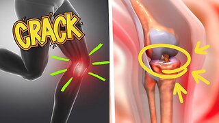 Is Your Knee Cracking? Here's When You Should Start Taking It Seriously