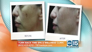 Learn how Turn Back Time Spa & Wellness Clinic can help improve your skin