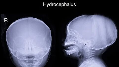 Open Panel discussion on Hhydrocephalus