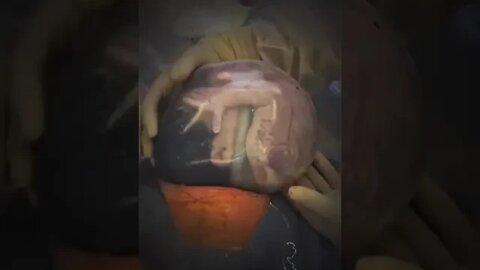 Watch the miracle of extracting the fetus from the mother's womb