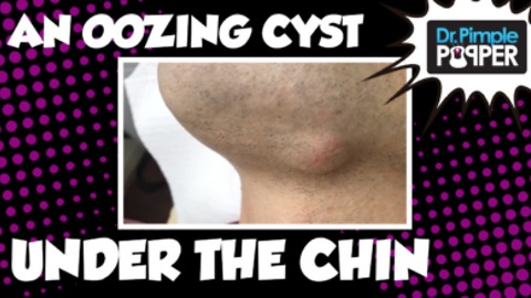 GOOEY CHIN CYST with Dr. Pimple Popper