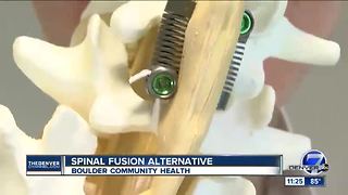 Spinal Fusion Alternative