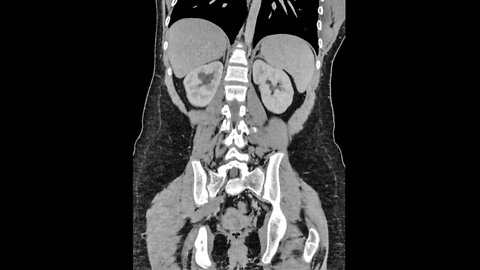 A Student Felt A Sharp Pain In Her Side. This Is How Her Organs Shut Down.