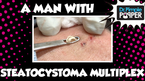 Dr Pimple Popper: A Man with Steatocystoma Multiplex: Session 1