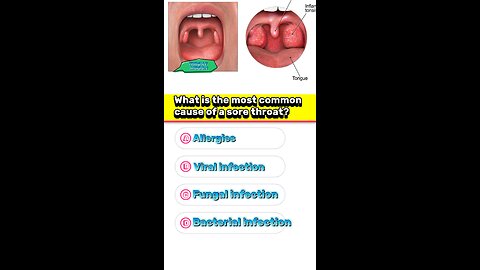 Throats infection question answer mcqs 🫁🫁 #pharmacologyexam #3dmedico #throat #hospital #disease