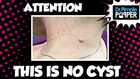 Attention: This is NOT a Cyst
