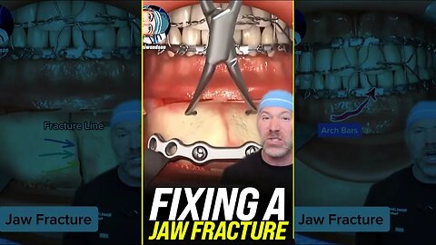 Fixing a Jaw Fracture 😱 #shorts