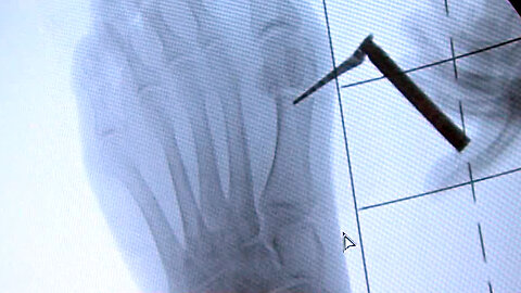 New revolutionary surgery to fix bunions only available in West Palm Beach