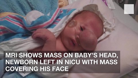 MRI Shows Mass on Baby’s Head, Newborn Left in NICU with Mass Covering His Face