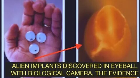 Alien Implant Found in Eyeball with Biological Camera