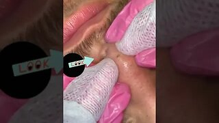 Pimple Popping Acne Treatment Blackhead Extraction