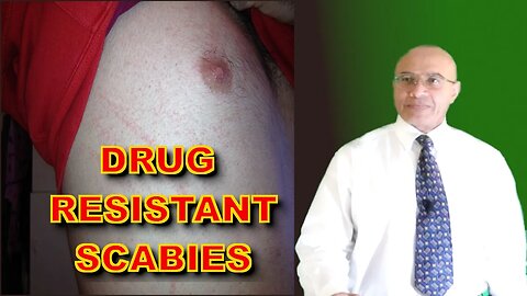 Scabies (Drug Resistance Emerging)
