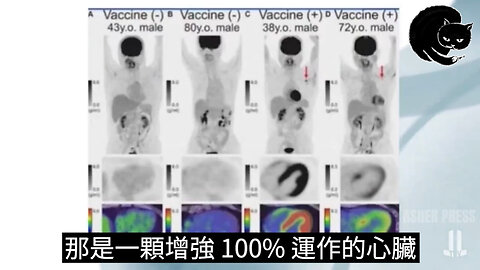 新冠疫苗導致心臟受損的證據, Dr. Chris Shoemaker