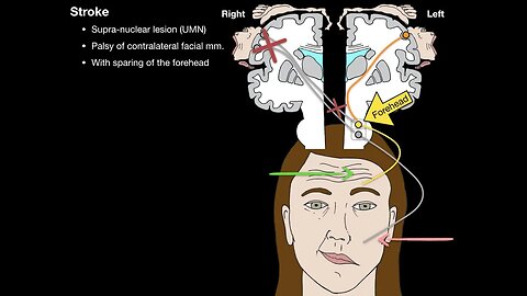 Bells Palsy and Stroke