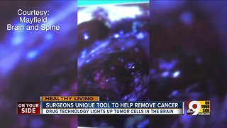 Surgeons use unique tool to remove cancer
