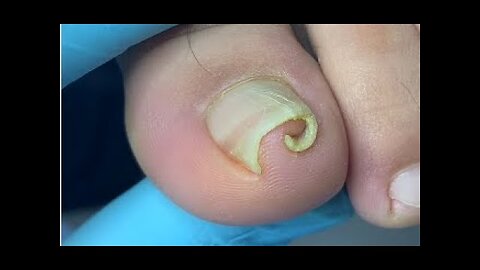 How to repair curled nail