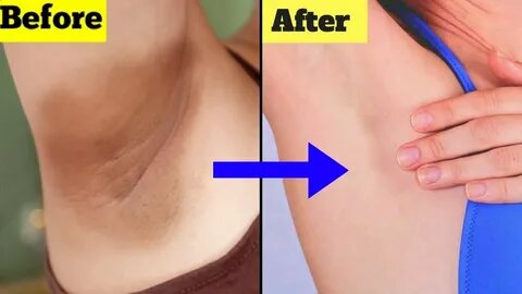 LIGHTEN UP YOUR ARMPITS IN LESS THAN 3 DAYS WITH THIS SOLUTION