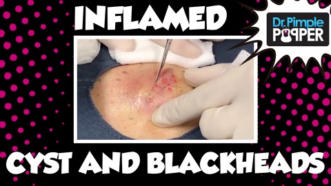 Inflamed Cyst AND Blackheads ala Favre Racouchot CORRECTED! :)
