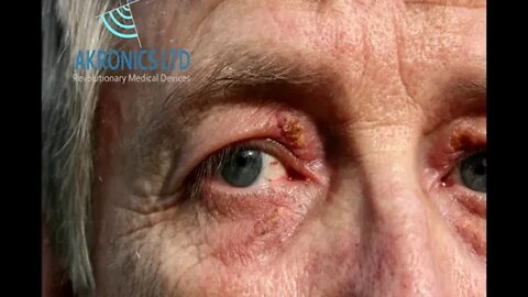 Xanthelasma Removal without TCA