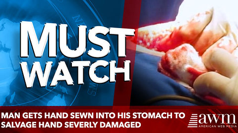 Man gets hand sewn into his stomach to salvage hand
