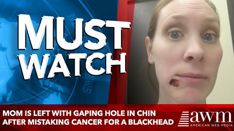 Mom Is Left With Gaping Hole In Chin After Mistaking Cancer For A Blackhead
